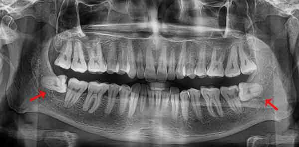 Protinio danties rovimas